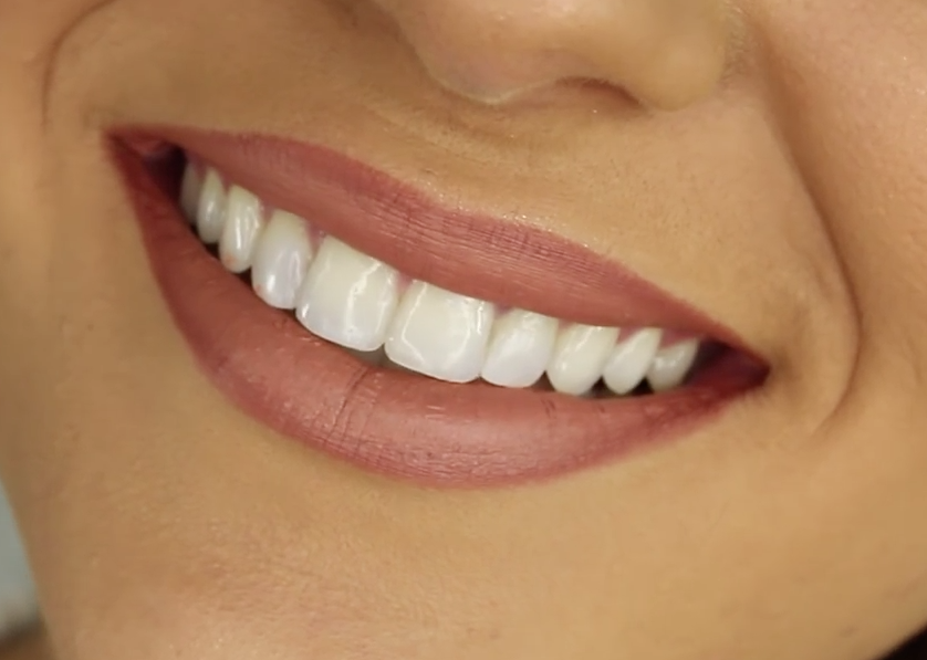 Achieve Your Dream Smile with Hamerink Dental Plymouth